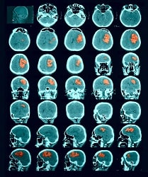 Cerebral CT Scan