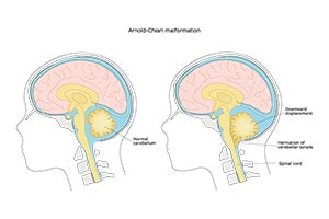 Chiari Malformation