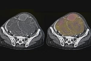 CT scan for ovarian cancer