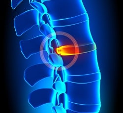 spinal disc injury settlements