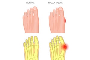 Hallux