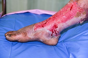 Patient with Leg Burns