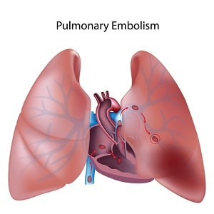 pulmonary embolism malpractice