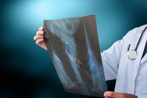 Bowel Obstruction X-Ray