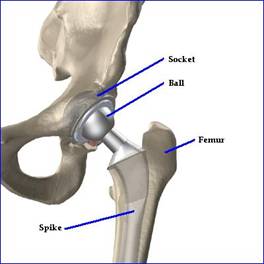 Femur Catheterization